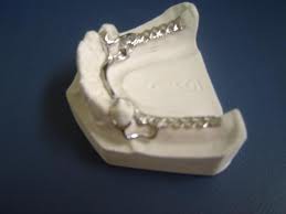 PPRM - PRÓTESE PARCIAL REMOVÍVEL METÁLICA