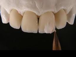 Coroa Veneer e Solidex